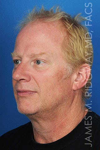 Nose Surgery (Rhinoplasty) Before & After Gallery - Patient 185057742 - Image 8