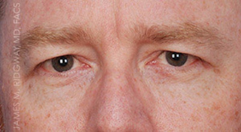 Eyelid Surgery (Blepharoplasty) Before & After Gallery - Patient 185057754 - Image 1