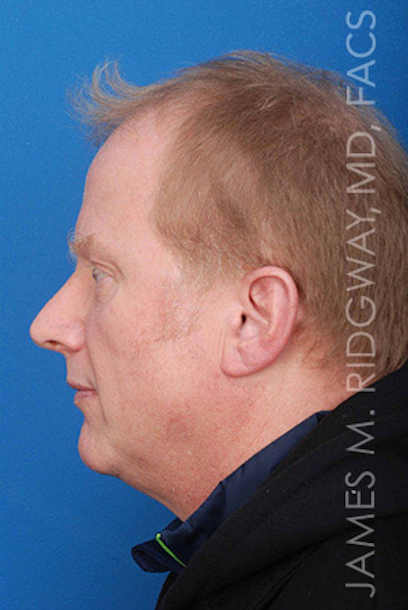 Nose Surgery (Rhinoplasty) Before & After Gallery - Patient 185057742 - Image 9
