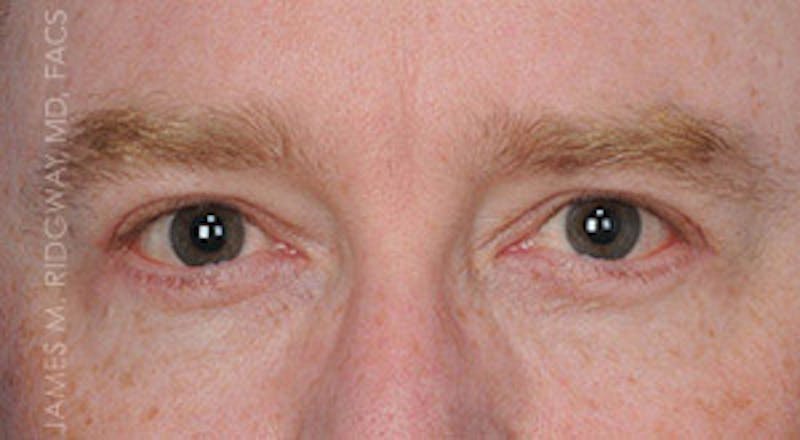 Eyelid Surgery (Blepharoplasty) Before & After Gallery - Patient 185057754 - Image 2