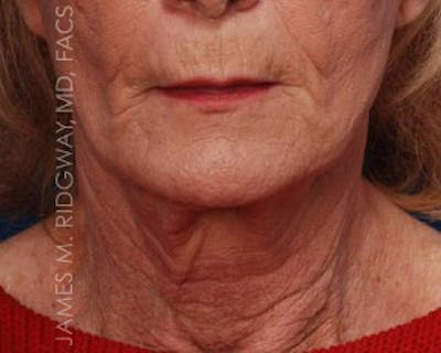 Facial Surgery (Facelift) Before & After Gallery - Patient 185057751 - Image 1