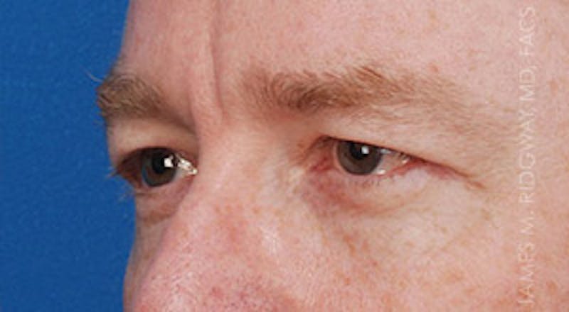 Eyelid Surgery (Blepharoplasty) Before & After Gallery - Patient 185057754 - Image 3