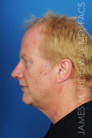 Nose Surgery (Rhinoplasty) Before & After Gallery - Patient 185057742 - Image 10