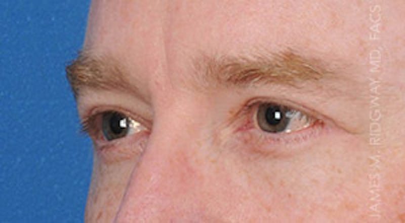 Eyelid Surgery (Blepharoplasty) Before & After Gallery - Patient 185057754 - Image 4