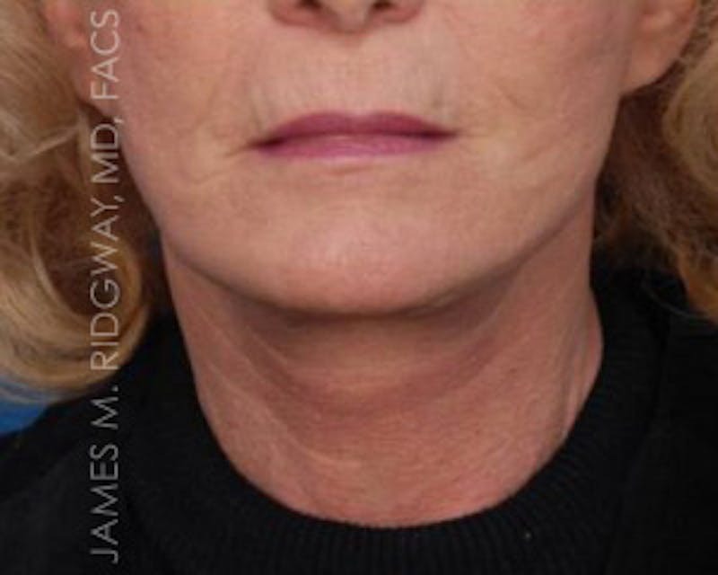 Facial Surgery (Facelift) Before & After Gallery - Patient 185057751 - Image 2