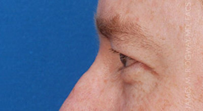 Eyelid Surgery (Blepharoplasty) Before & After Gallery - Patient 185057754 - Image 5