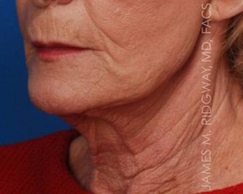 Facial Surgery (Facelift) Before & After Gallery - Patient 185057751 - Image 3