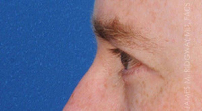 Eyelid Surgery (Blepharoplasty) Before & After Gallery - Patient 185057754 - Image 6