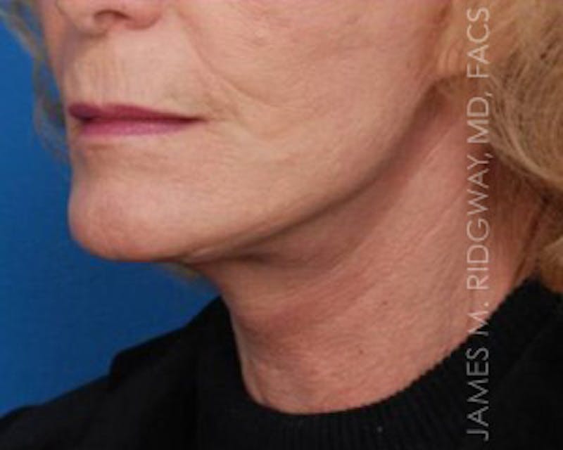 Facial Surgery (Facelift) Before & After Gallery - Patient 185057751 - Image 4