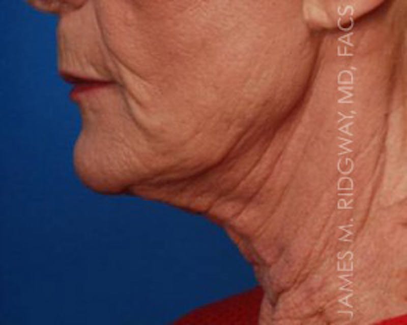 Facial Surgery (Facelift) Before & After Gallery - Patient 185057751 - Image 5