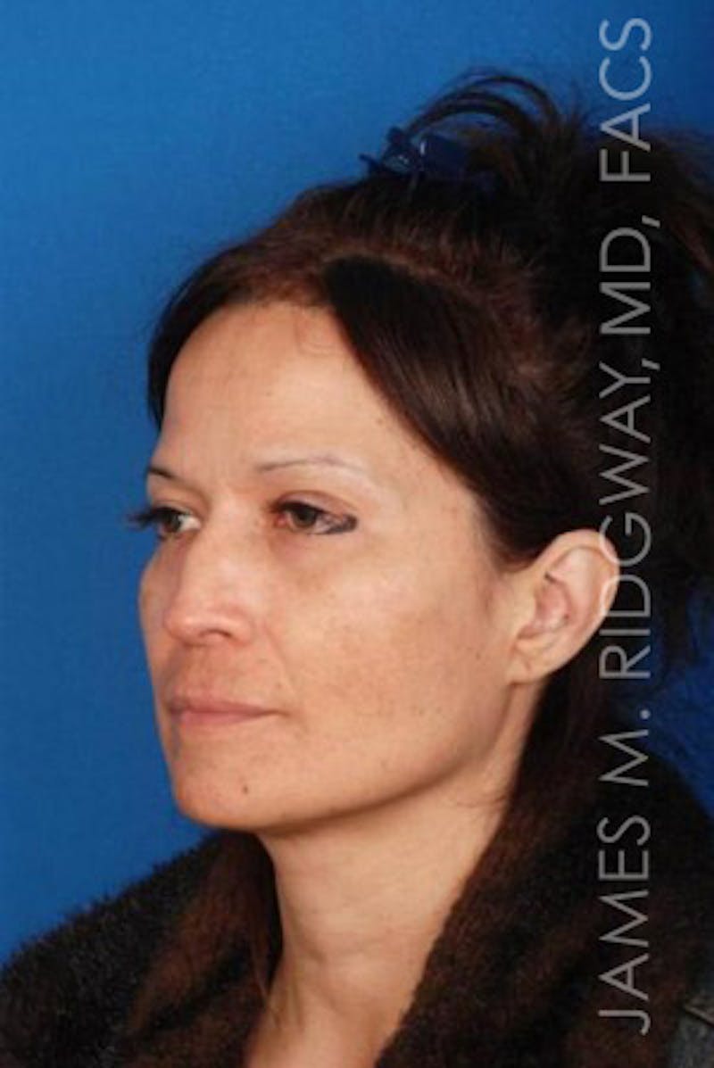 Nose Surgery (Rhinoplasty) Before & After Gallery - Patient 185057757 - Image 3