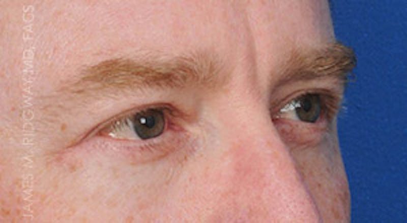 Eyelid Surgery (Blepharoplasty) Before & After Gallery - Patient 185057754 - Image 8