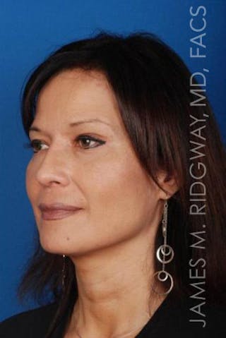 Nose Surgery (Rhinoplasty) Before & After Gallery - Patient 185057757 - Image 4