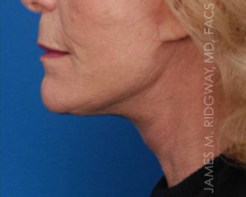 Facial Surgery (Facelift) Before & After Gallery - Patient 185057751 - Image 6