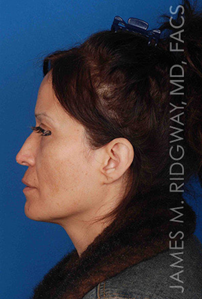 Nose Surgery (Rhinoplasty) Before & After Gallery - Patient 185057757 - Image 5
