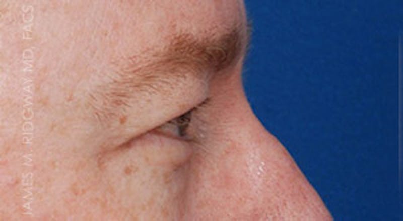 Eyelid Surgery (Blepharoplasty) Before & After Gallery - Patient 185057754 - Image 9