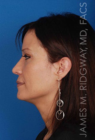 Nose Surgery (Rhinoplasty) Before & After Gallery - Patient 185057757 - Image 6