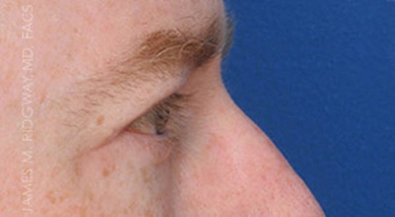 Eyelid Surgery (Blepharoplasty) Before & After Gallery - Patient 185057754 - Image 10
