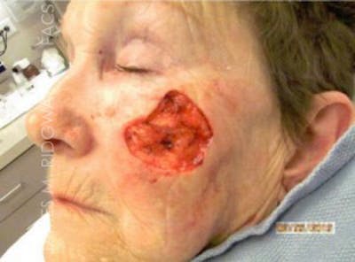 Mohs Reconstruction (Warning: Graphic Images) Before & After Gallery - Patient 185057755 - Image 1