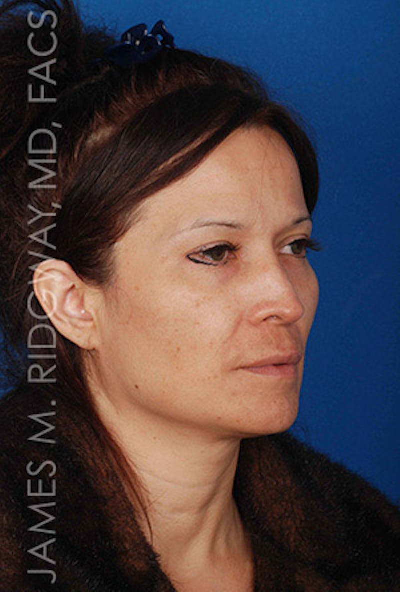 Nose Surgery (Rhinoplasty) Before & After Gallery - Patient 185057757 - Image 7