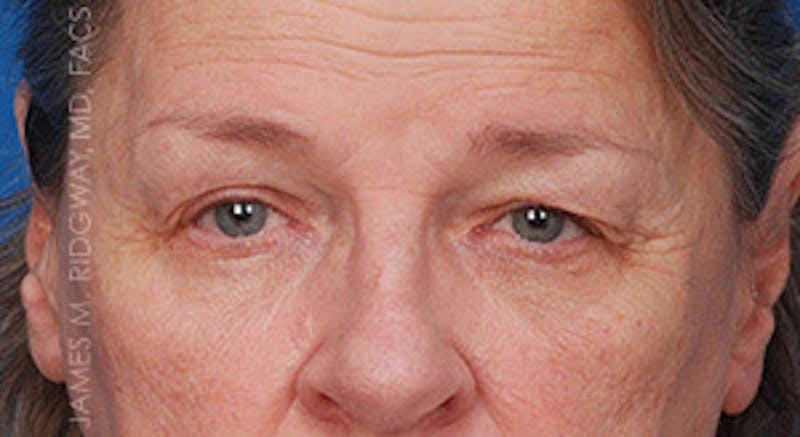 Eyelid Surgery (Blepharoplasty) Before & After Gallery - Patient 185057756 - Image 1