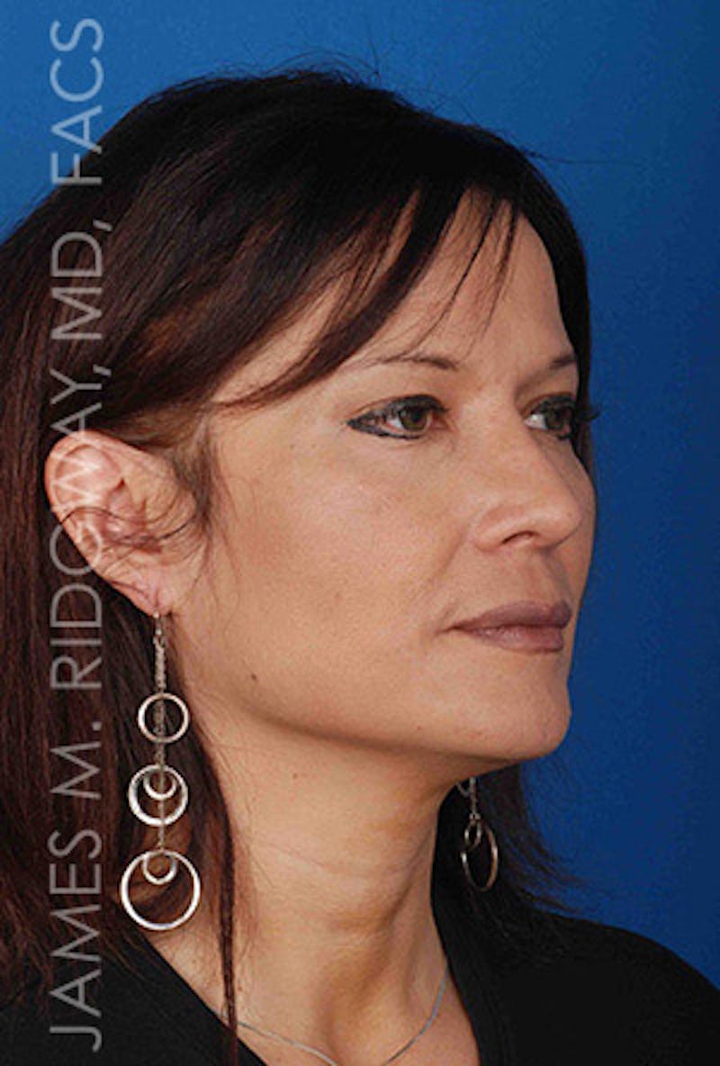 Nose Surgery (Rhinoplasty) Before & After Gallery - Patient 185057757 - Image 8