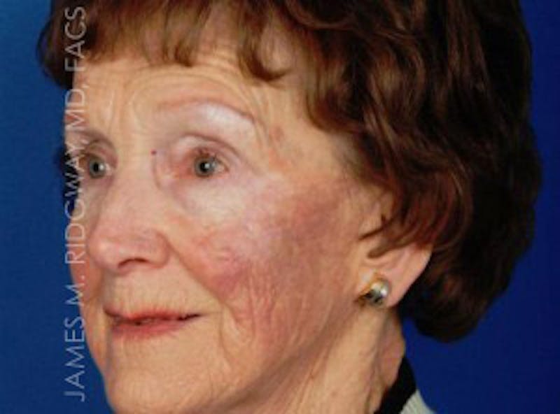 Mohs Reconstruction (Warning: Graphic Images) Before & After Gallery - Patient 185057755 - Image 2