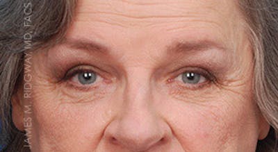 Eyelid Surgery (Blepharoplasty) Before & After Gallery - Patient 185057756 - Image 2