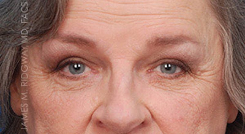 Eyelid Surgery (Blepharoplasty) Before & After Gallery - Patient 185057756 - Image 2