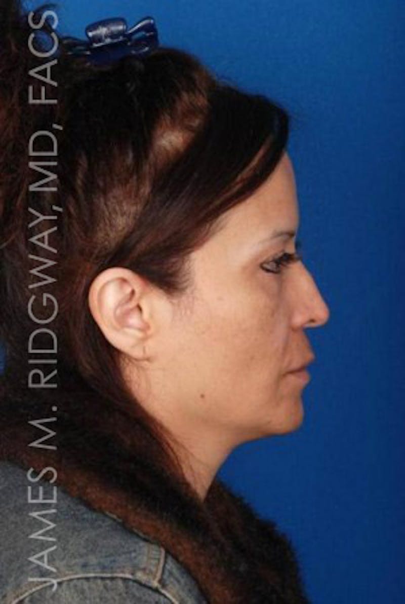 Nose Surgery (Rhinoplasty) Before & After Gallery - Patient 185057757 - Image 9