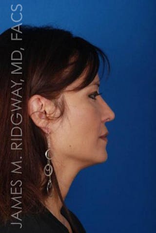 Nose Surgery (Rhinoplasty) Before & After Gallery - Patient 185057757 - Image 10