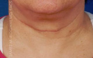 Mohs Reconstruction (Warning: Graphic Images) Before & After Gallery - Patient 185057758 - Image 2