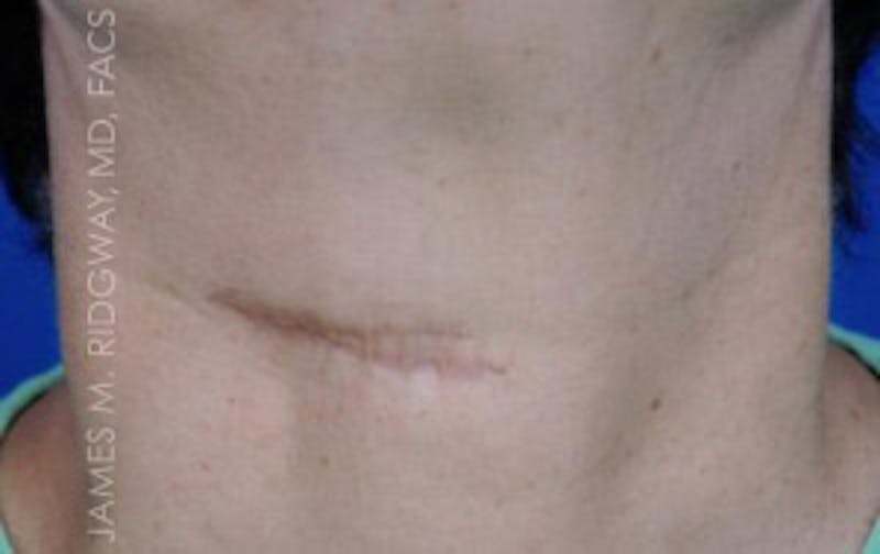 Mohs Reconstruction (Warning: Graphic Images) Before & After Gallery - Patient 185057758 - Image 3