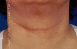 Mohs Reconstruction (Warning: Graphic Images) Before & After Gallery - Patient 185057758 - Image 4