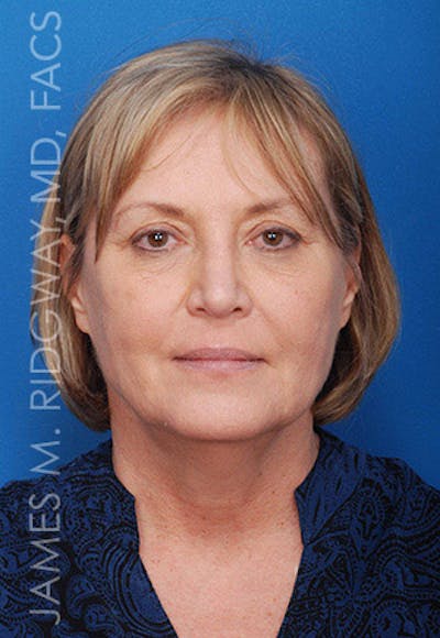 Nose Surgery (Rhinoplasty) Before & After Gallery - Patient 185069765 - Image 2