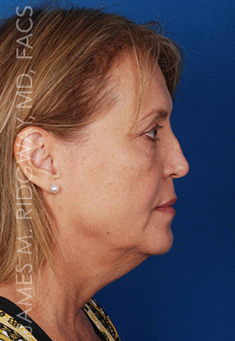 Nose Surgery (Rhinoplasty) Before & After Gallery - Patient 185069765 - Image 3