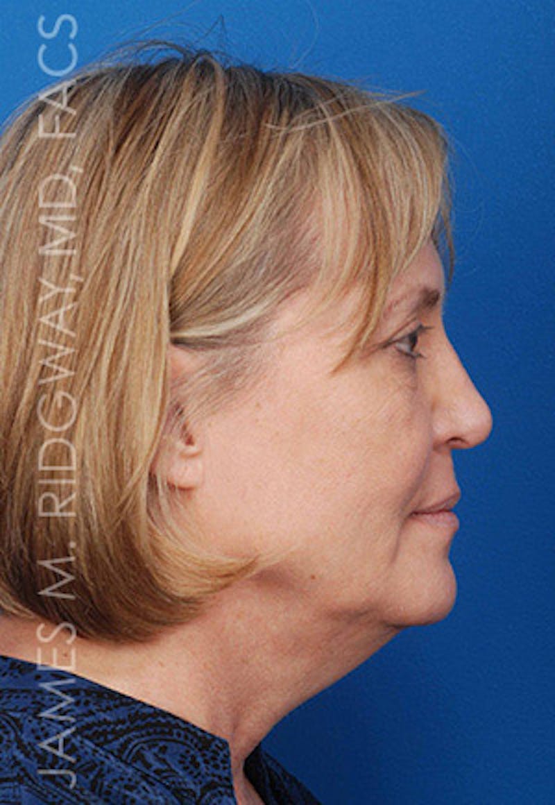 Nose Surgery (Rhinoplasty) Before & After Gallery - Patient 185069765 - Image 4
