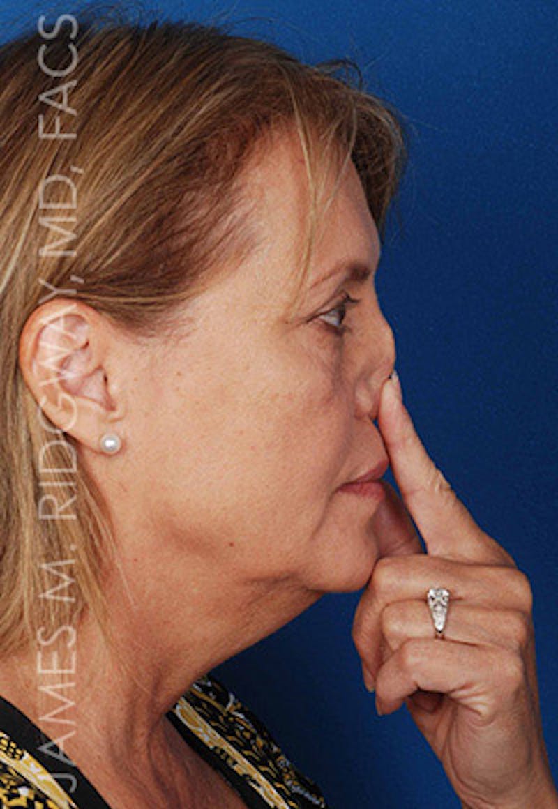 Nose Surgery (Rhinoplasty) Before & After Gallery - Patient 185069765 - Image 5