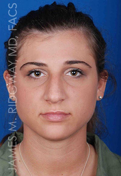 Nose Surgery (Rhinoplasty) Before & After Gallery - Patient 185108277 - Image 1