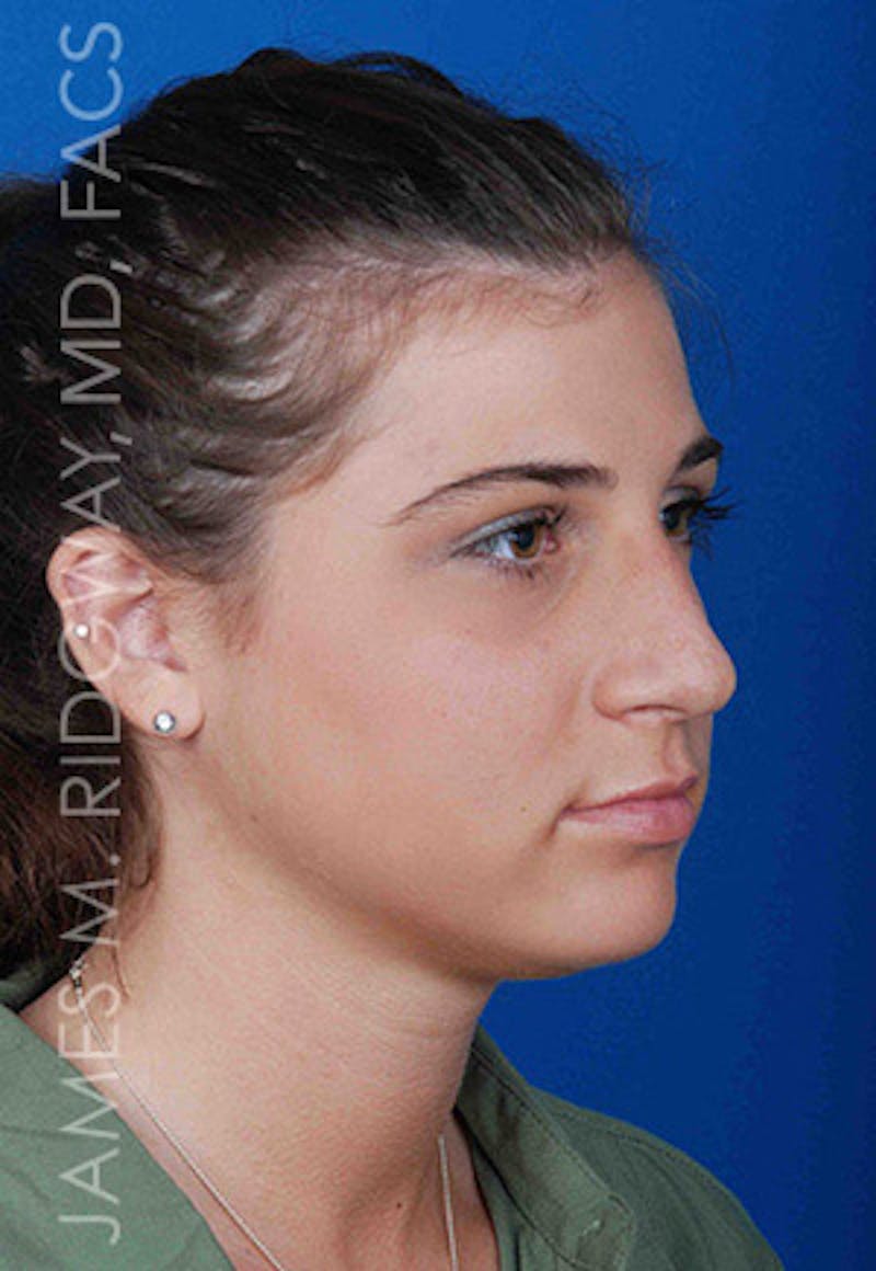 Nose Surgery (Rhinoplasty) Before & After Gallery - Patient 185108277 - Image 3