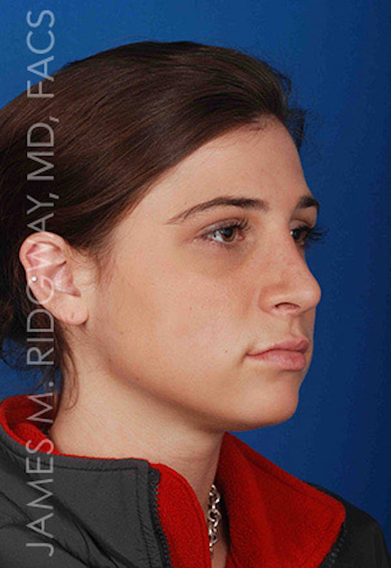 Nose Surgery (Rhinoplasty) Before & After Gallery - Patient 185108277 - Image 4