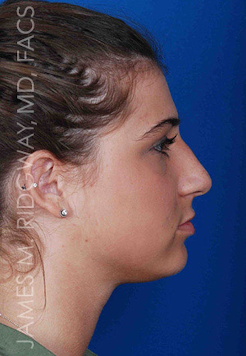 Nose Surgery (Rhinoplasty) Before & After Gallery - Patient 185108277 - Image 5
