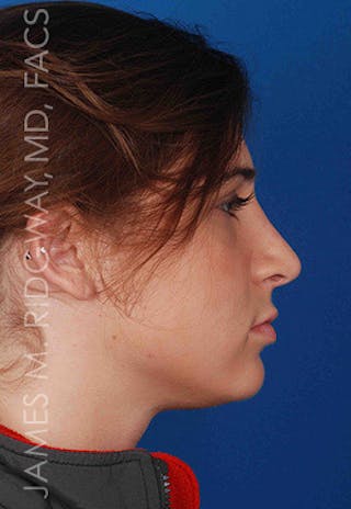 Nose Surgery (Rhinoplasty) Before & After Gallery - Patient 185108277 - Image 6