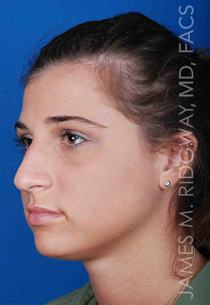 Nose Surgery (Rhinoplasty) Before & After Gallery - Patient 185108277 - Image 7