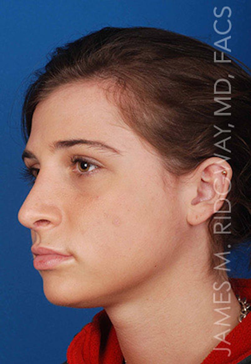 Nose Surgery (Rhinoplasty) Before & After Gallery - Patient 185108277 - Image 8