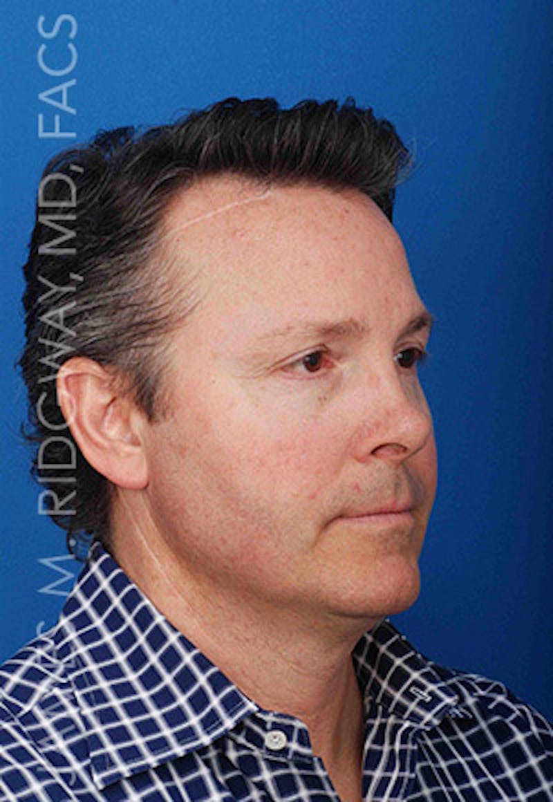 Nose Surgery (Rhinoplasty) Before & After Gallery - Patient 185108293 - Image 3