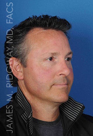 Nose Surgery (Rhinoplasty) Before & After Gallery - Patient 185108293 - Image 4