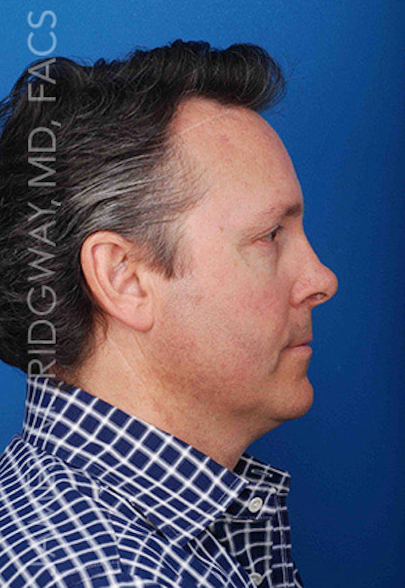 Nose Surgery (Rhinoplasty) Before & After Gallery - Patient 185108293 - Image 5