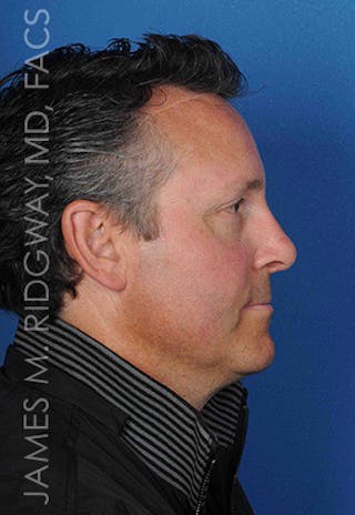Nose Surgery (Rhinoplasty) Before & After Gallery - Patient 185108293 - Image 6