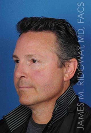 Nose Surgery (Rhinoplasty) Before & After Gallery - Patient 185108293 - Image 8